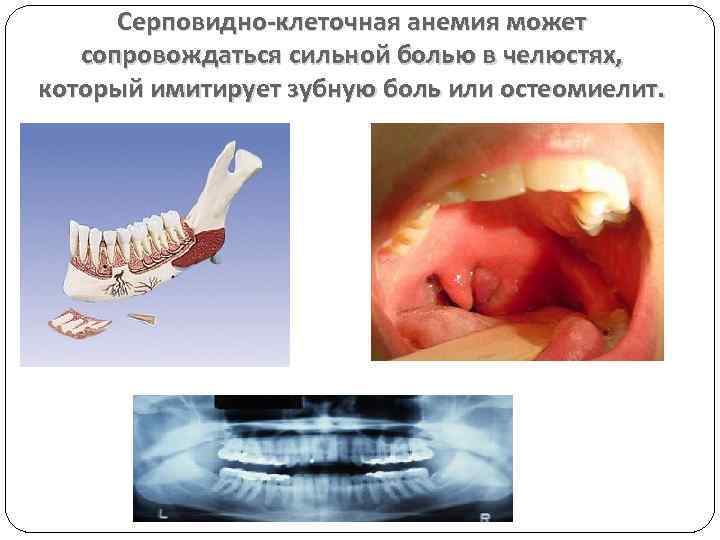 Серповидно-клеточная анемия может сопровождаться сильной болью в челюстях, который имитирует зубную боль или остеомиелит.