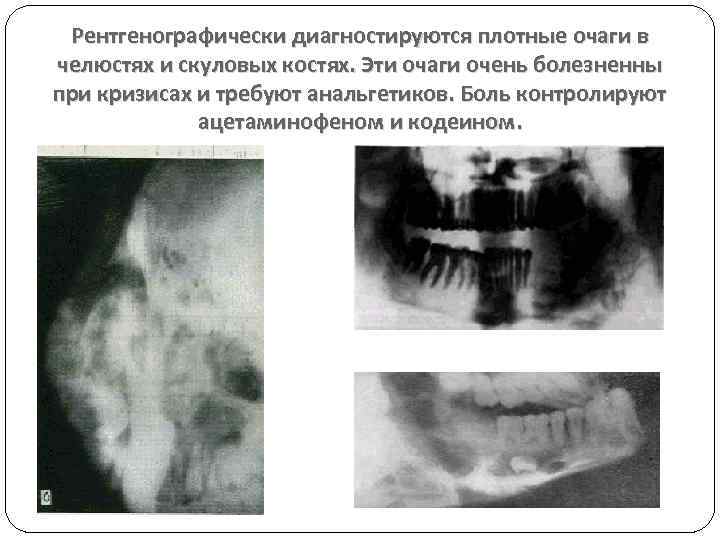 Рентгенографически диагностируются плотные очаги в челюстях и скуловых костях. Эти очаги очень болезненны при