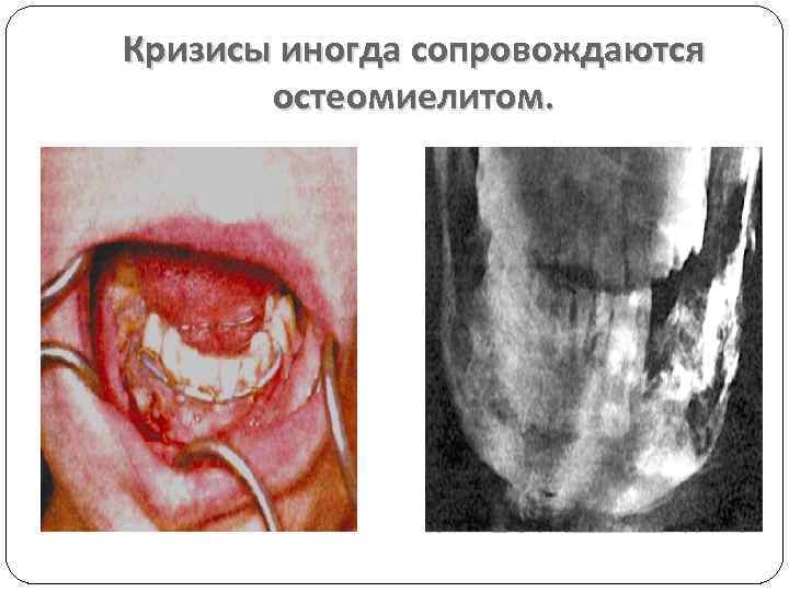 Кризисы иногда сопровождаются остеомиелитом. 
