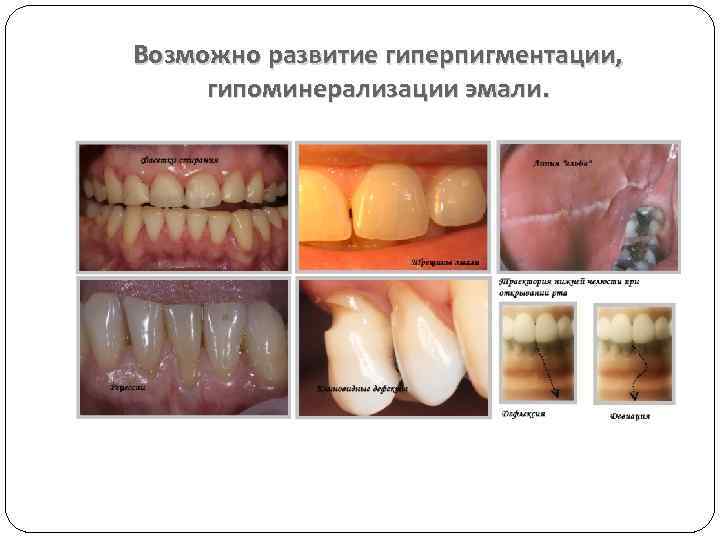Возможно развитие гиперпигментации, гипоминерализации эмали. 