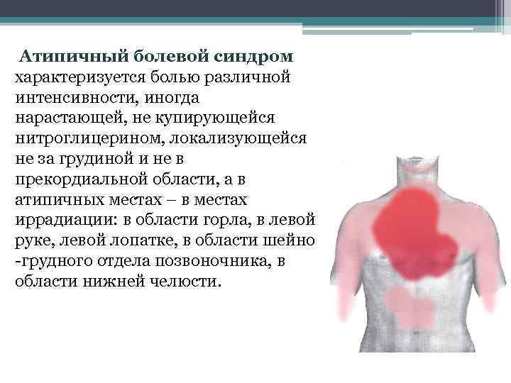 Иррадиация в левую лопатку. Болевой синдром Окс характеризуется:. Боль за грудиной не купируется нитроглицерином. Атипичный болевой синдром.