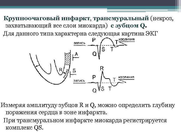 Крупноочаговый инфаркт, трансмуральный (некроз, захватывающий все слои миокарда) с зубцом Q. Для данного типа