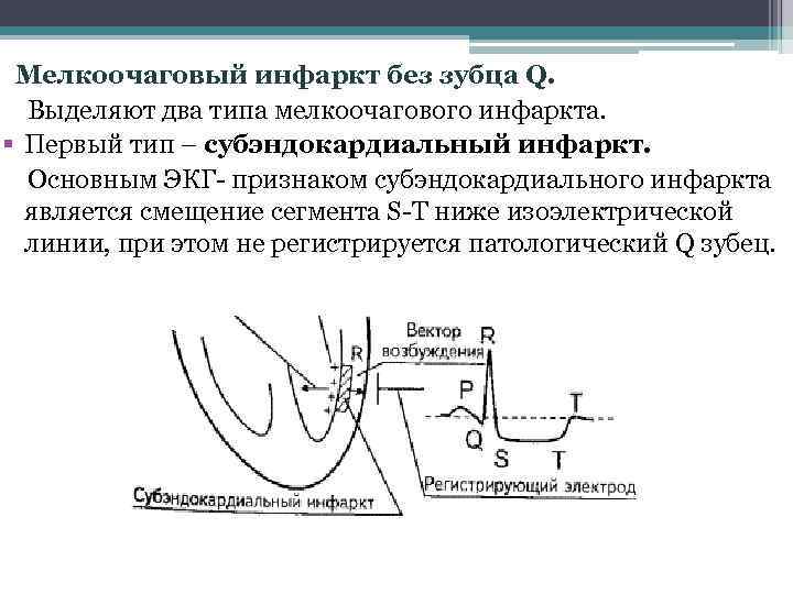 Признаки мелкоочагового инфаркта миокарда