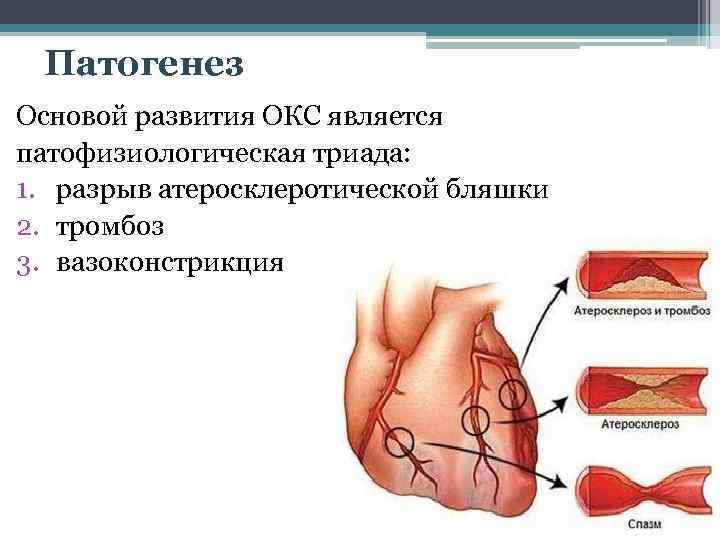 Патогенез Основой развития ОКС является патофизиологическая триада: 1. разрыв атеросклеротической бляшки 2. тромбоз 3.