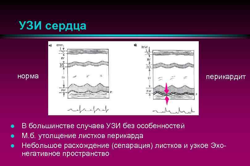 УЗИ сердца норма l l l перикардит В большинстве случаев УЗИ без особенностей М.