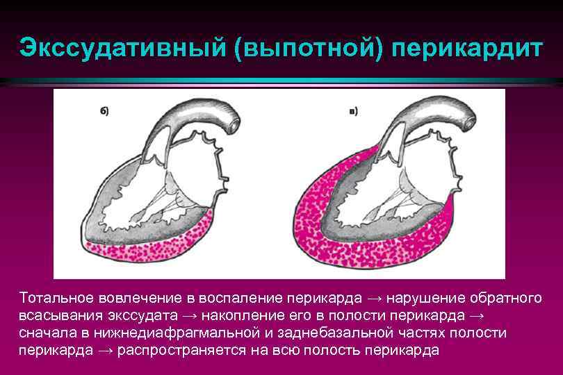 Перикардиты госпитальная терапия презентация