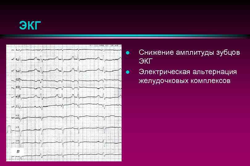 ЭКГ l l Снижение амплитуды зубцов ЭКГ Электрическая альтернация желудочковых комплексов 