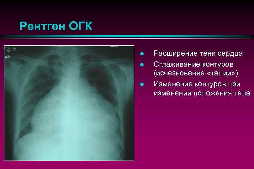 Рентген ОГК l l l Расширение тени сердца Сглаживание контуров (исчезновение «талии» ) Изменение