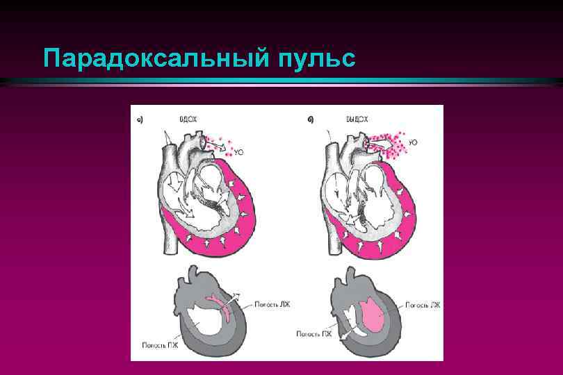 Парадоксальный пульс 