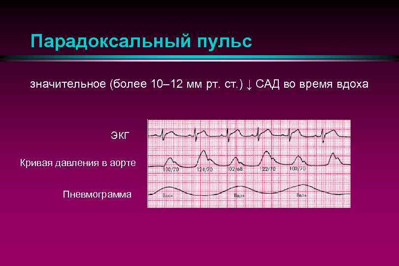 Парадоксальный пульс значительное (более 10– 12 мм рт. ст. ) ↓ САД во время