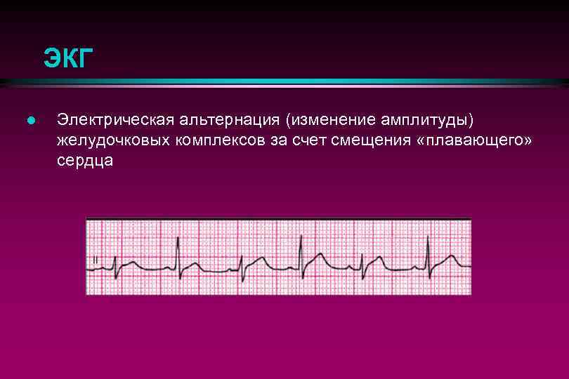 ЭКГ l Электрическая альтернация (изменение амплитуды) желудочковых комплексов за счет смещения «плавающего» сердца 