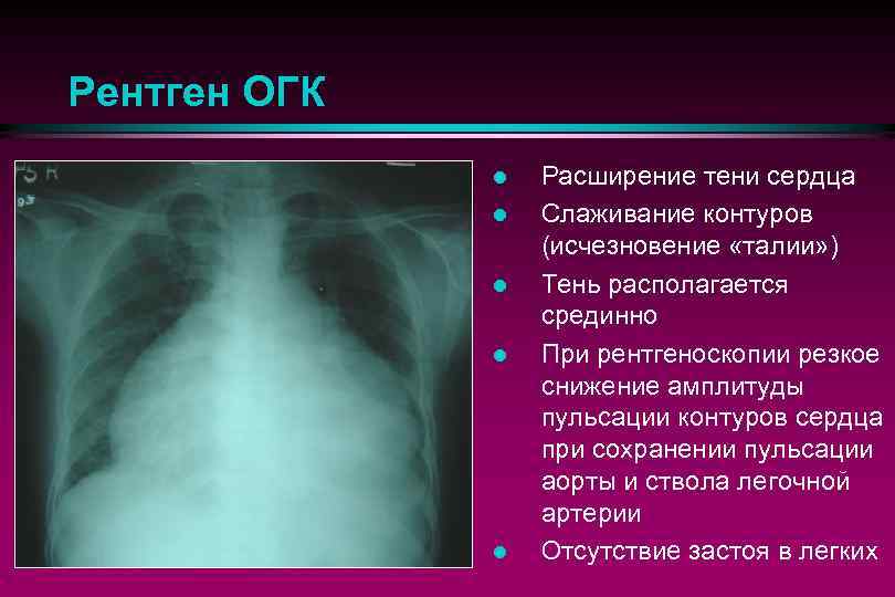 Рентген ОГК l l l Расширение тени сердца Слаживание контуров (исчезновение «талии» ) Тень