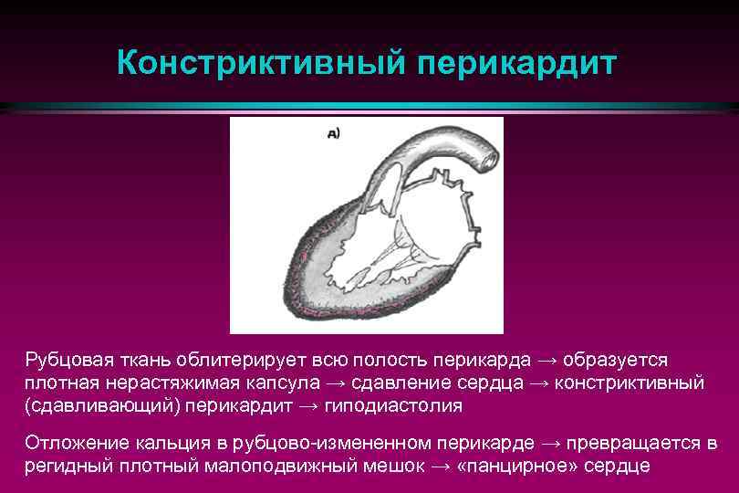 Констриктивный перикардит Рубцовая ткань облитерирует всю полость перикарда → образуется плотная нерастяжимая капсула →