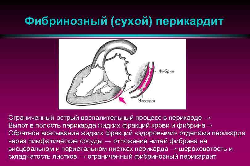 Фибринозный (сухой) перикардит Ограниченный острый воспалительный процесс в перикарде → Выпот в полость перикарда