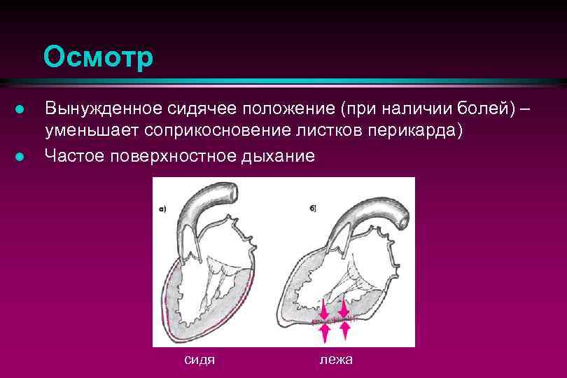 Триада бека. Перикардит обследование. Осмотр при перикардите. Перикардит клиника. Вынужденное сидячее положение.