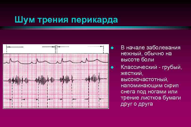 Шум трения перикарда. Перикардит шум трения перикарда. Шум трения перикарда аускультация. Шум при перикардите. Шум трения перикарда причины.