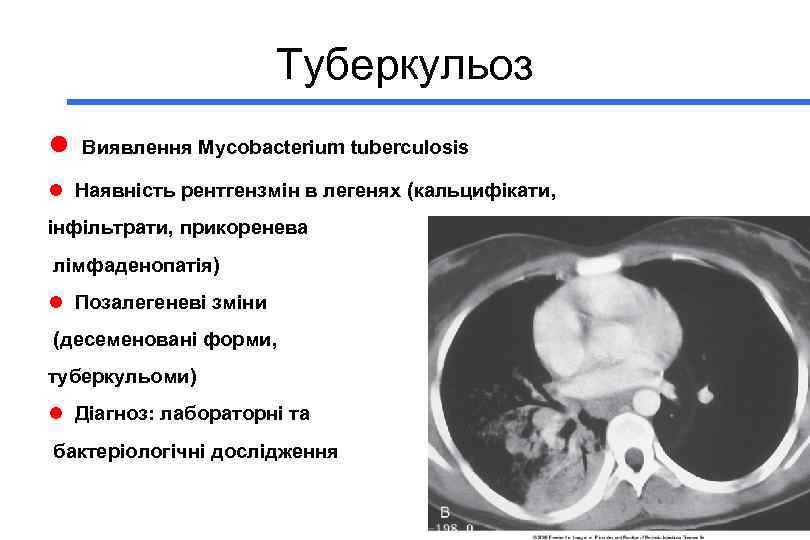 Туберкульоз l Виявлення Mycobacterium tuberculosis l Наявність рентгензмін в легенях (кальцифікати, інфільтрати, прикоренева лімфаденопатія)