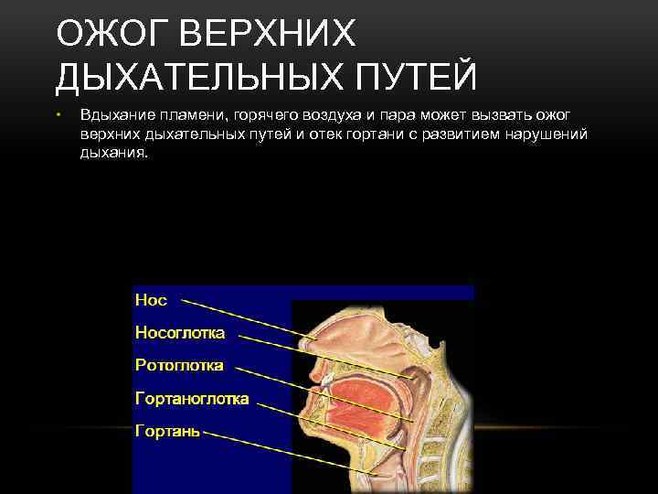 Ожог верхних дыхательных