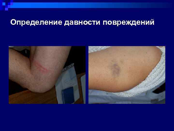 Определение давности повреждений 