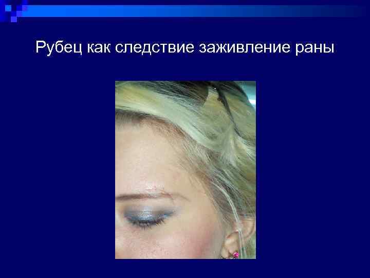 Рубец как следствие заживление раны 