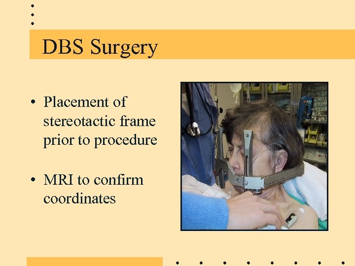 DBS Surgery • Placement of stereotactic frame prior to procedure • MRI to confirm