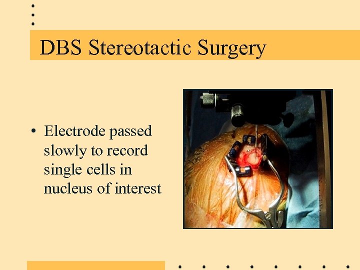 DBS Stereotactic Surgery • Electrode passed slowly to record single cells in nucleus of