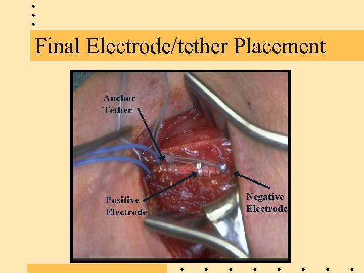 Final Electrode/tether Placement Anchor Tether Positive Electrode Negative Electrode 