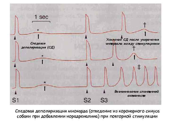 Следовая деполяризация (СД) Усиление СД после укорочения интервала между стимуляциями Возникновения спонтанной активности Следовая