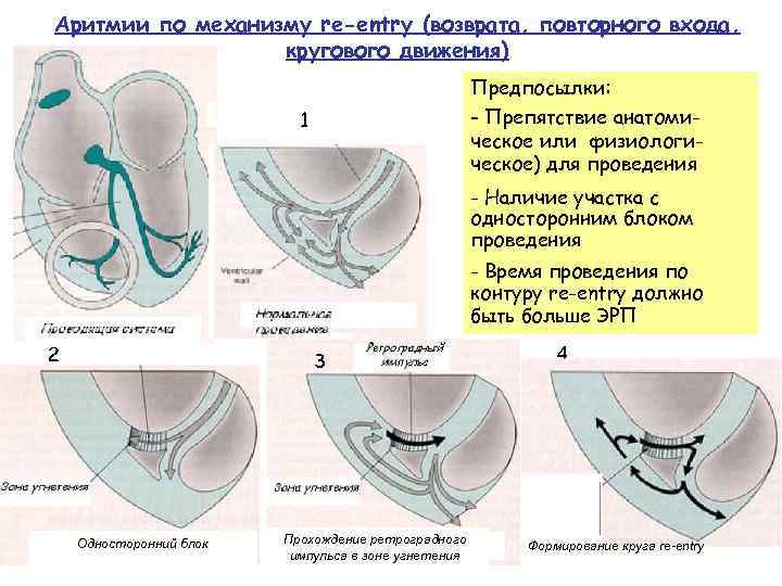 Аритмии по механизму re-entry (возврата, повторного входа, кругового движения) Предпосылки: - Препятствие анатомическое или