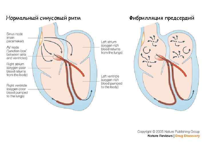Нормальный синусовый ритм Фибрилляция предсердий 