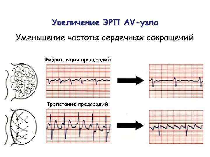 Увеличение ЭРП AV-узла Уменьшение частоты сердечных сокращений Фибрилляция предсердий Трепетание предсердий 
