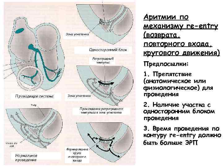 Зона угнетения Односторонний блок Ретроградный импульс Проводящая система Зона угнетения Прохождение ретроградного импульса в