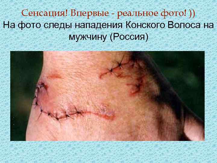 Сенсация! Впервые - реальное фото! )) На фото следы нападения Конского Волоса на мужчину