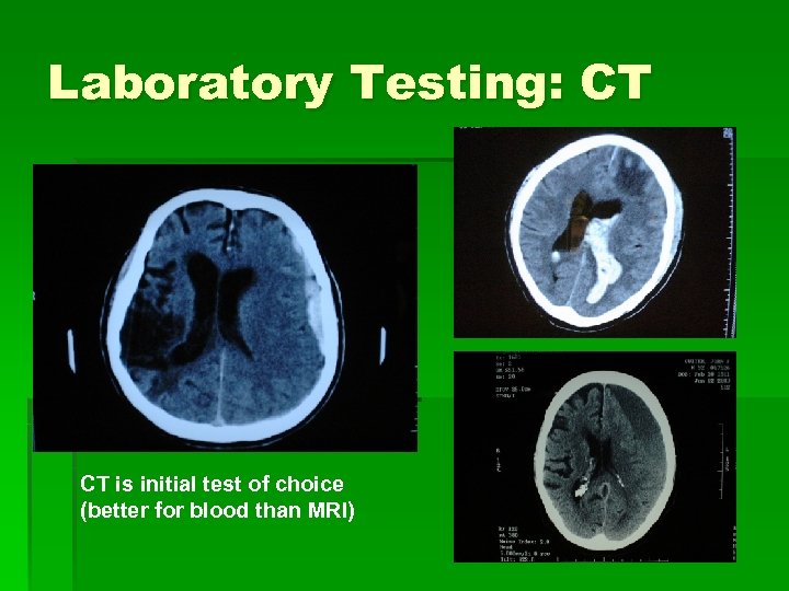 Laboratory Testing: CT CT is initial test of choice (better for blood than MRI)