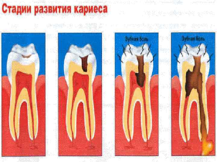 Стадии кариеса. Этапы формирования кариеса. Степени развития кариеса. Начальный этап развития кариеса. Начальная стадия развития кариеса.