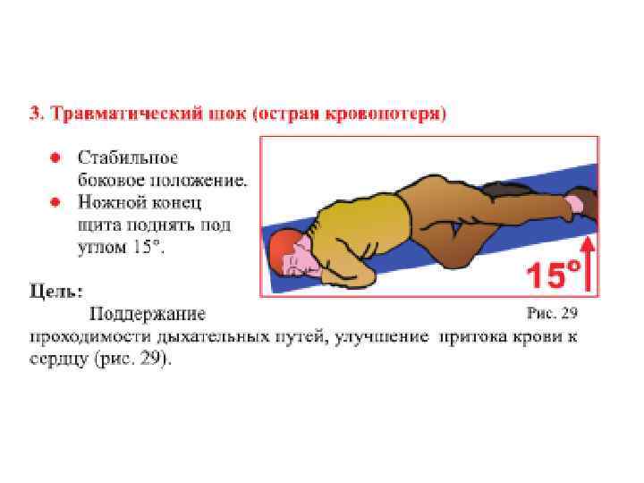 Положение пострадавших при острой кровопотере