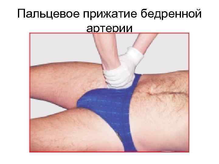 Пальцевое прижатие бедренной артерии 