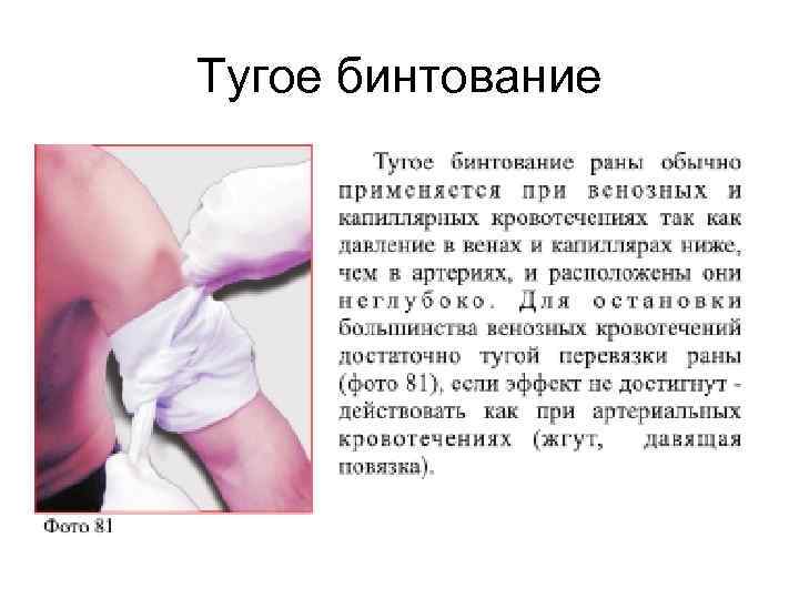 Тугое бинтование 