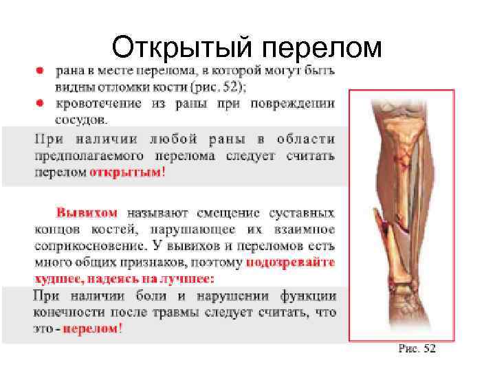 Открытый перелом 