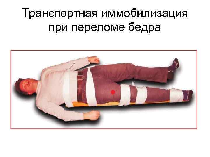 Транспортная иммобилизация при переломе бедра 