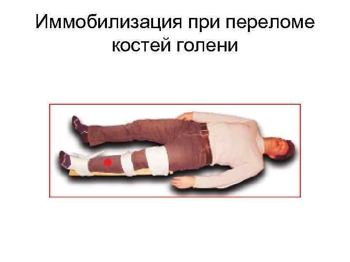Иммобилизация при переломе костей голени 