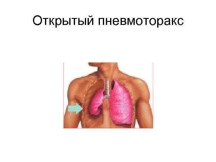 Открытый пневмоторакс