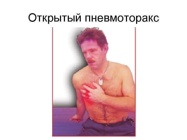 Открытый пневмоторакс 