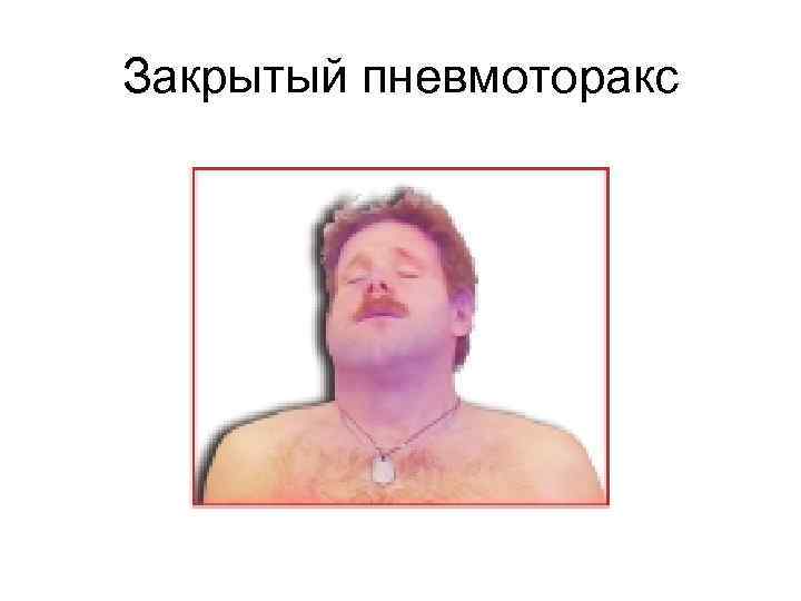 Закрытый пневмоторакс 
