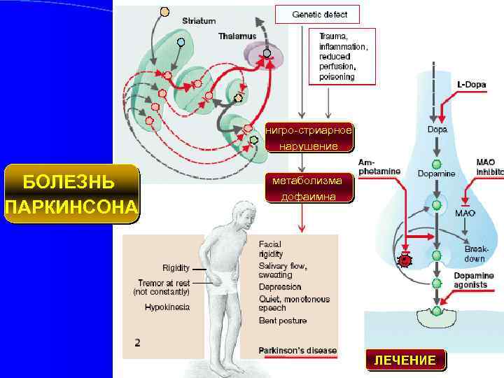 нигро-стриарное нарушение БОЛЕЗНЬ ПАРКИНСОНА метаболизма дофаимна ЛЕЧЕНИЕ 