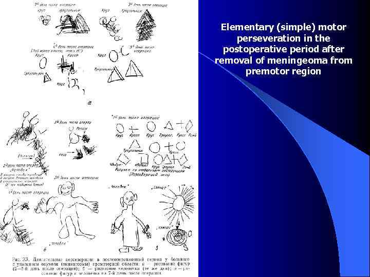 Elementary (simple) motor perseveration in the postoperative period after removal of meningeoma from premotor