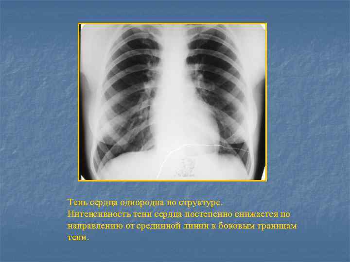 Тени сердца. Тень сердца на рентгене. Интенсивность тени на рентгенограмме. Тень сердца без особенностей. Интенсивность затемнения на рентгене.