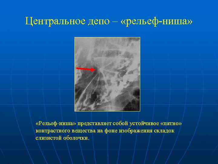 Центральное депо – «рельеф-ниша» «Рельеф-ниша» представляет собой устойчивое «пятно» контрастного вещества на фоне изображения
