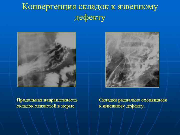 Конвергенция складок к язвенному дефекту Продольная направленность складок слизистой в норме. Складки радиально сходящиеся