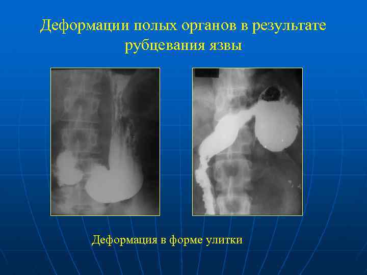 Деформации полых органов в результате рубцевания язвы Деформация в форме улитки 